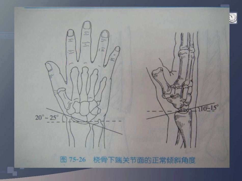 桡骨远端骨折(2)_第4页