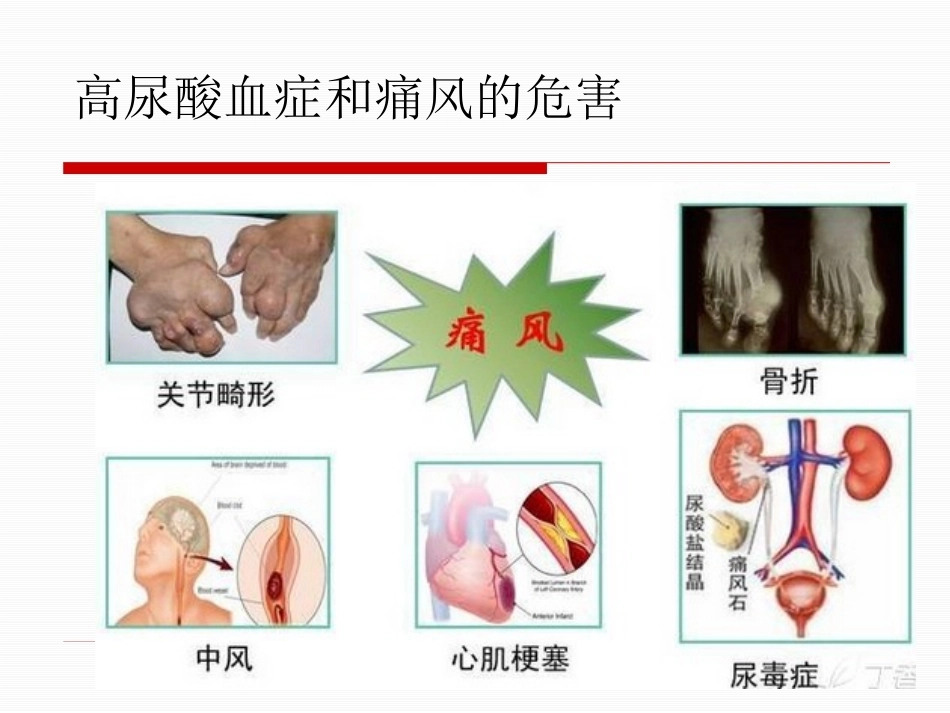 痛风性关节炎的规范化治疗2_第5页