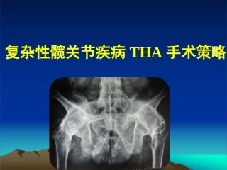 复杂性髋关节THA系列一（3）