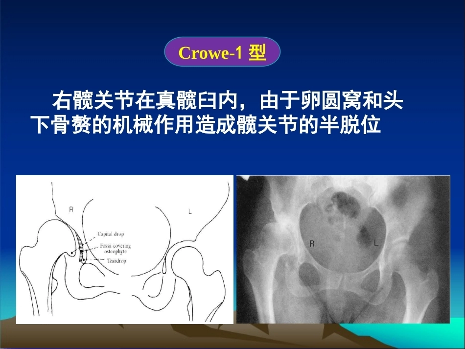 复杂性髋关节THA系列一（3）_第10页