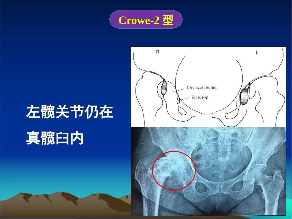 复杂性髋关节THA系列一（3）_第11页