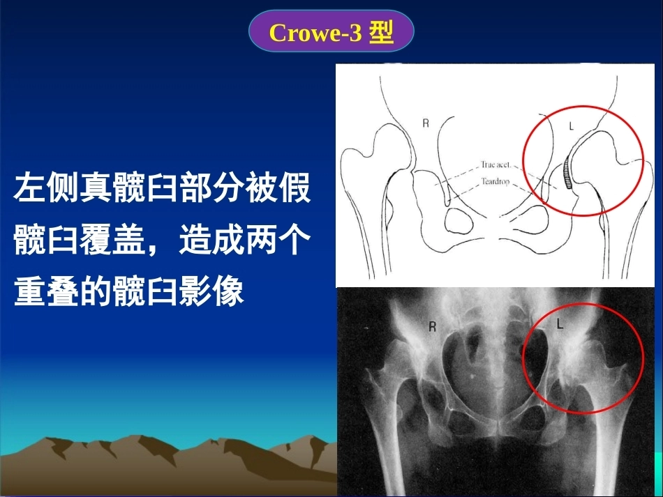 复杂性髋关节THA系列一（3）_第12页