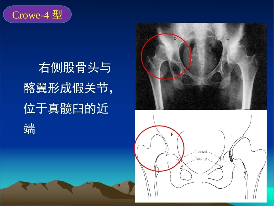 复杂性髋关节THA系列一（3）_第13页