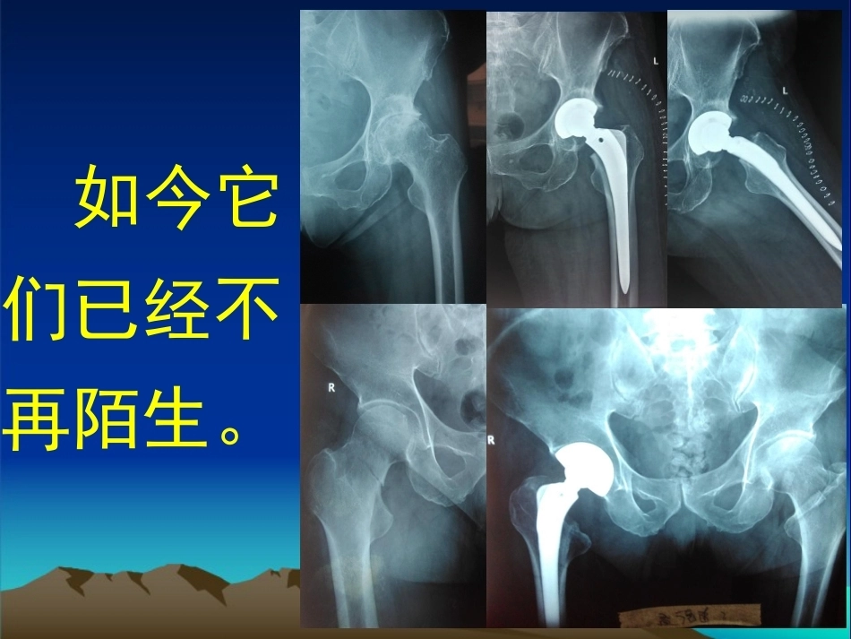 复杂性髋关节THA系列一（3）_第2页