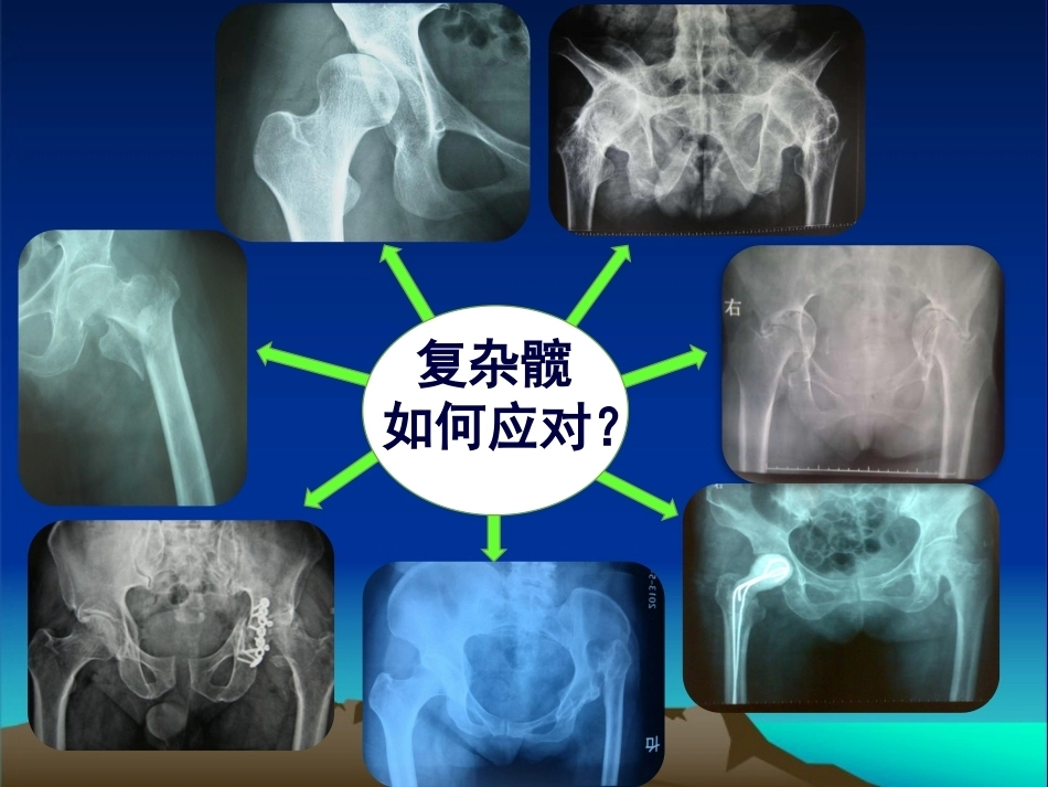 复杂性髋关节THA系列一（3）_第3页