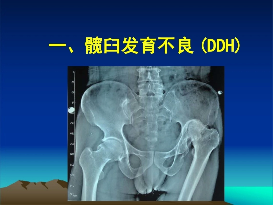 复杂性髋关节THA系列一（3）_第5页