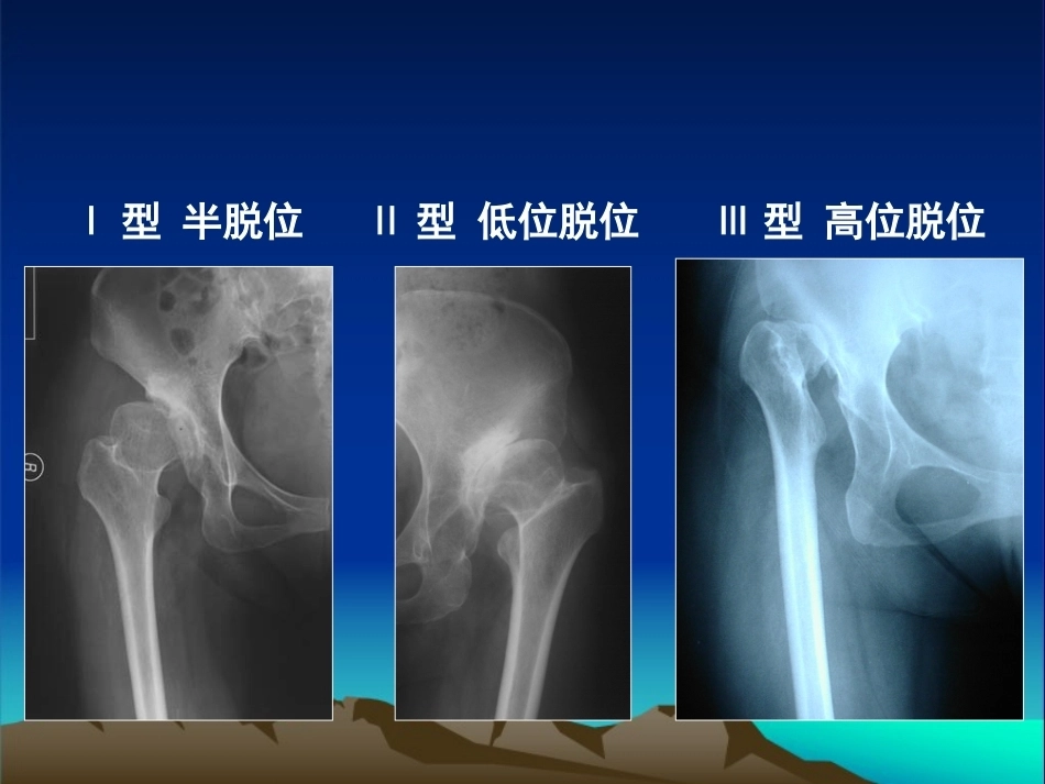 复杂性髋关节THA系列一（3）_第8页