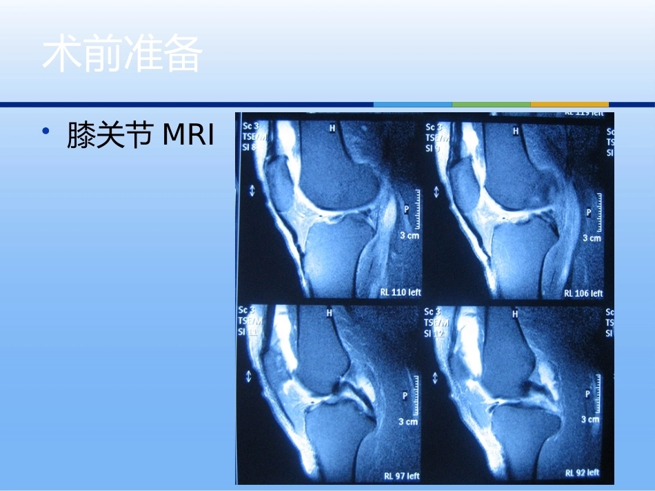 膝关节单髁置换（3）_第10页