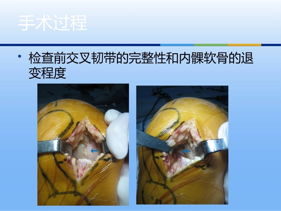 膝关节单髁置换（3）_第13页