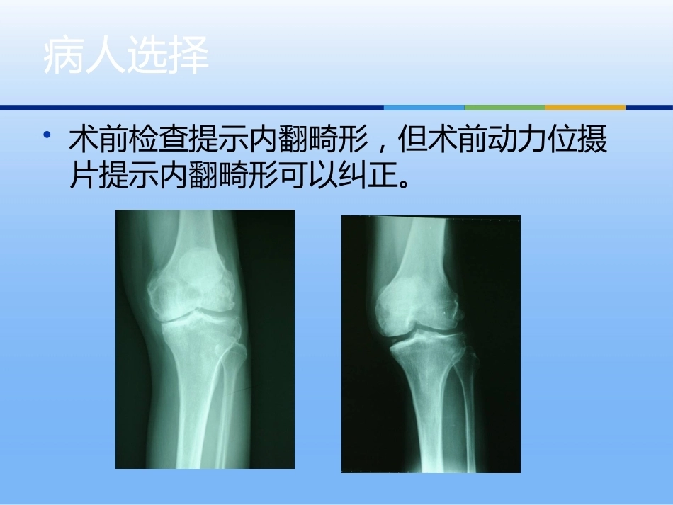 膝关节单髁置换（3）_第4页