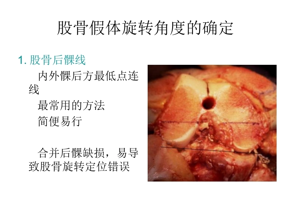 全膝关节置换术力线(3)_第14页