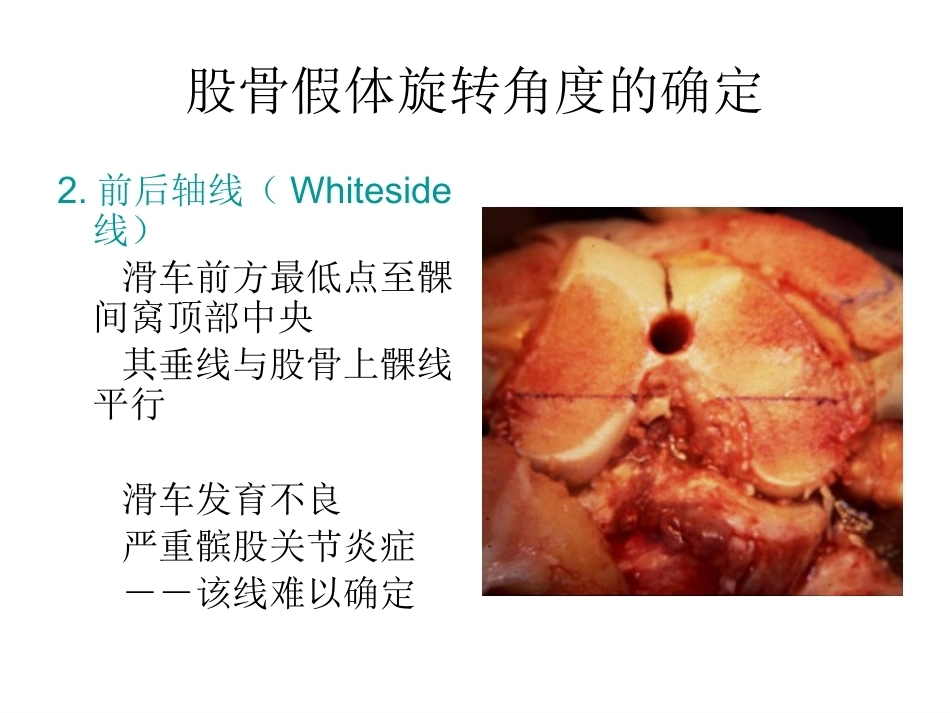 全膝关节置换术力线(3)_第15页