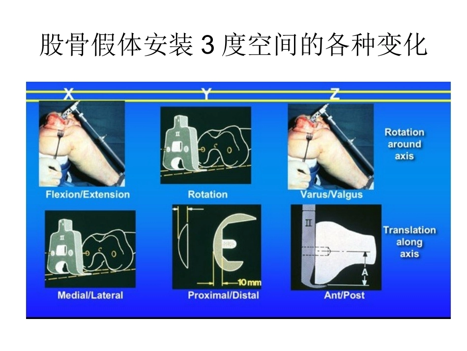 全膝关节置换术力线(3)_第8页