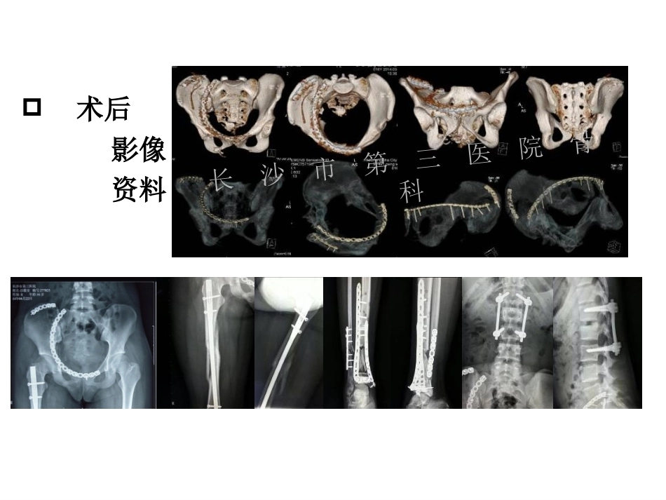 3D打印技术在骨科临床的应用_第10页