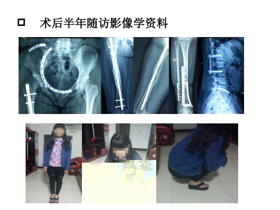 3D打印技术在骨科临床的应用_第11页