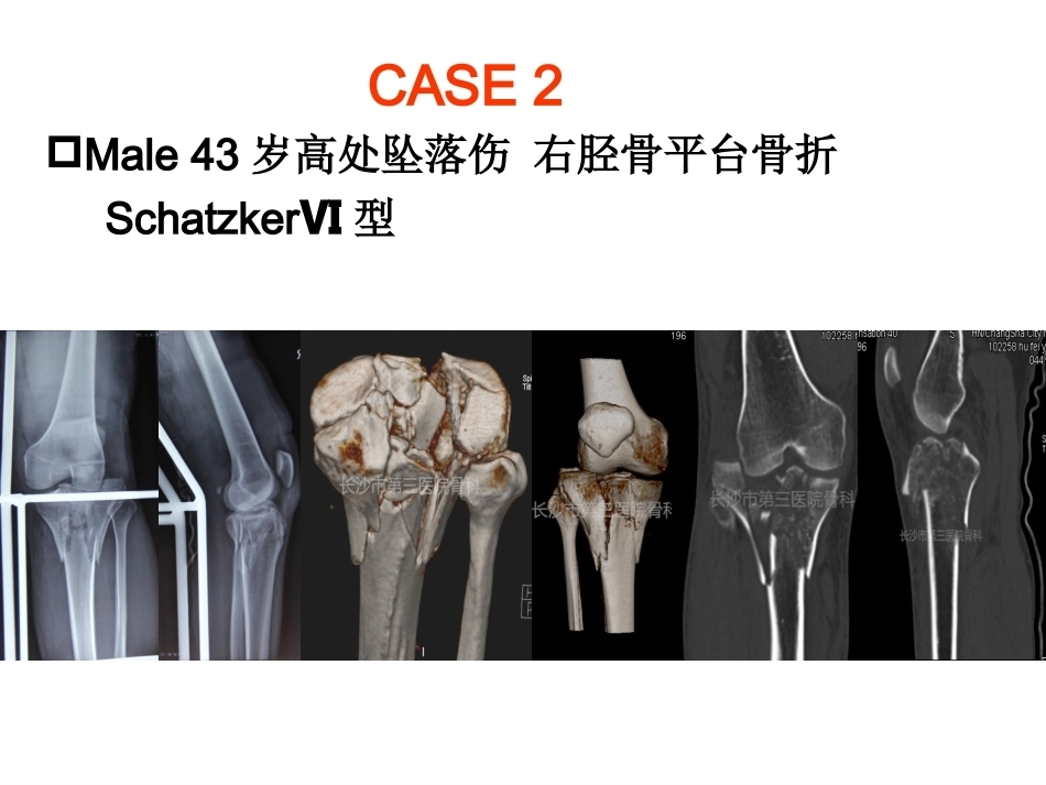 3D打印技术在骨科临床的应用_第12页