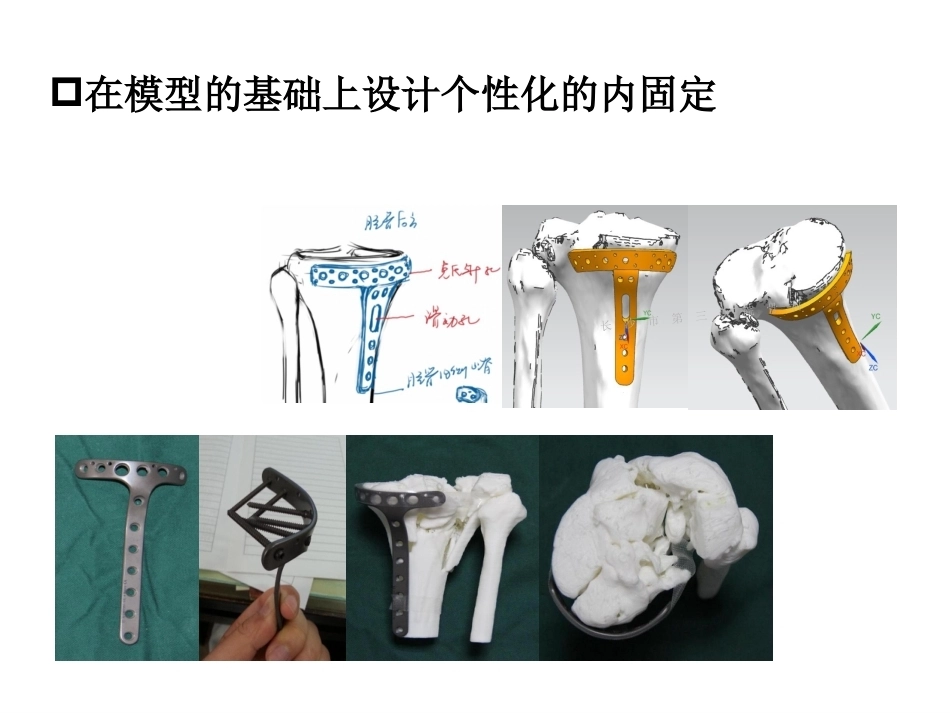 3D打印技术在骨科临床的应用_第13页