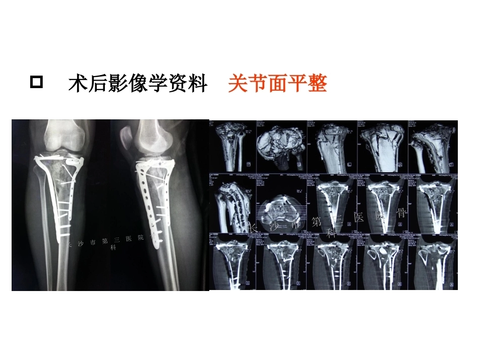 3D打印技术在骨科临床的应用_第14页