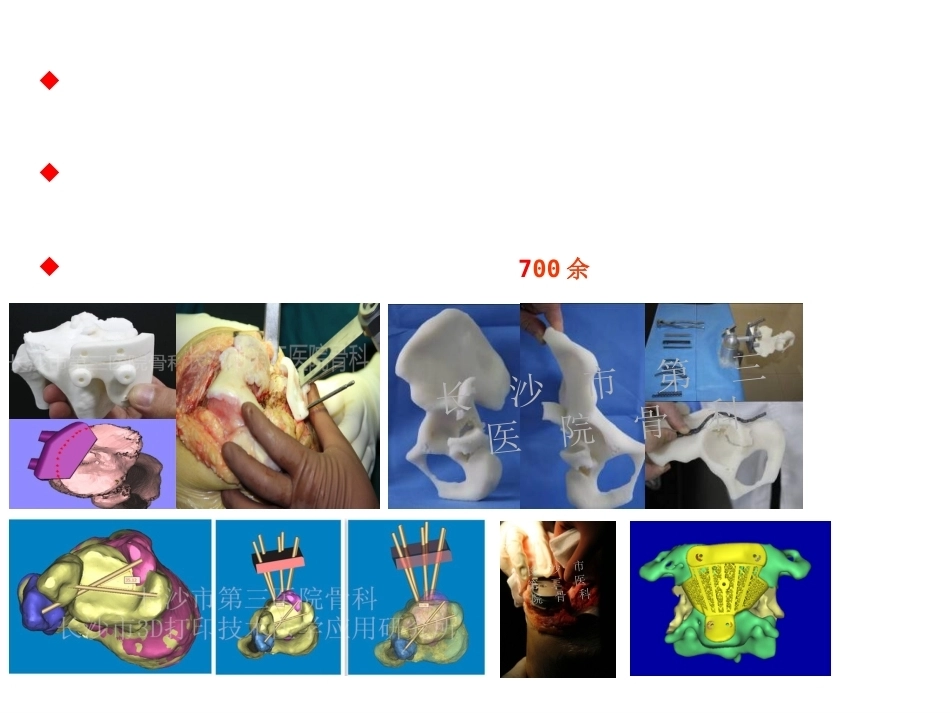 3D打印技术在骨科临床的应用_第6页