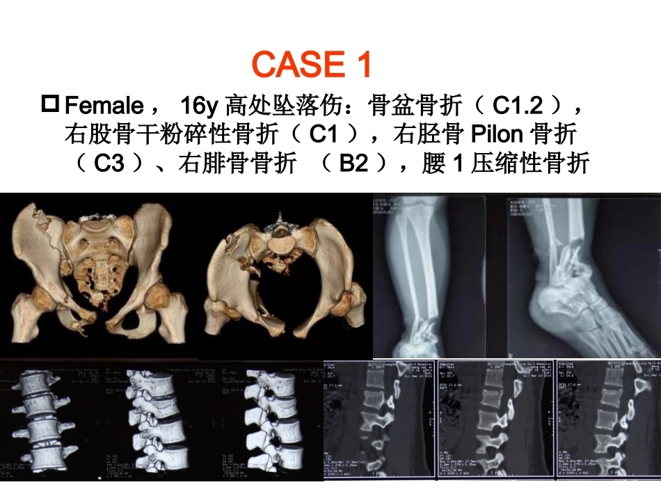 3D打印技术在骨科临床的应用_第8页