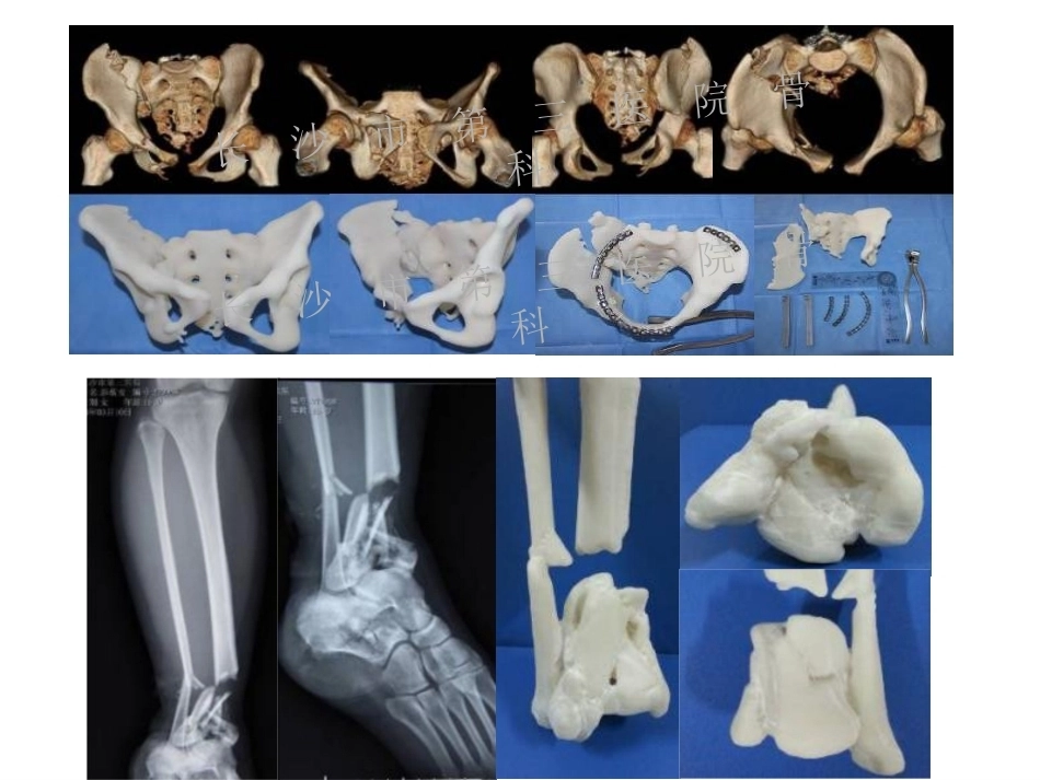 3D打印技术在骨科临床的应用_第9页
