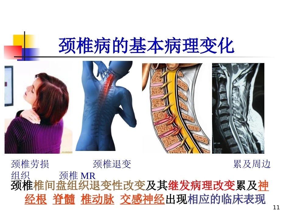 颈椎病的诊断与治疗(3)_第11页