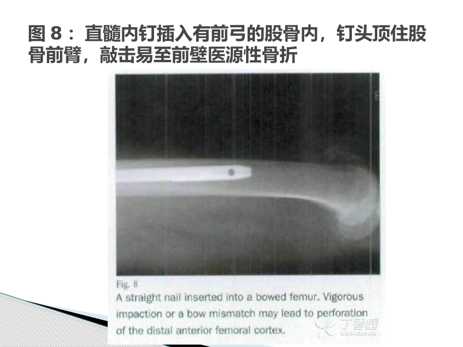 3.转子间骨折的十个手术技巧_第11页