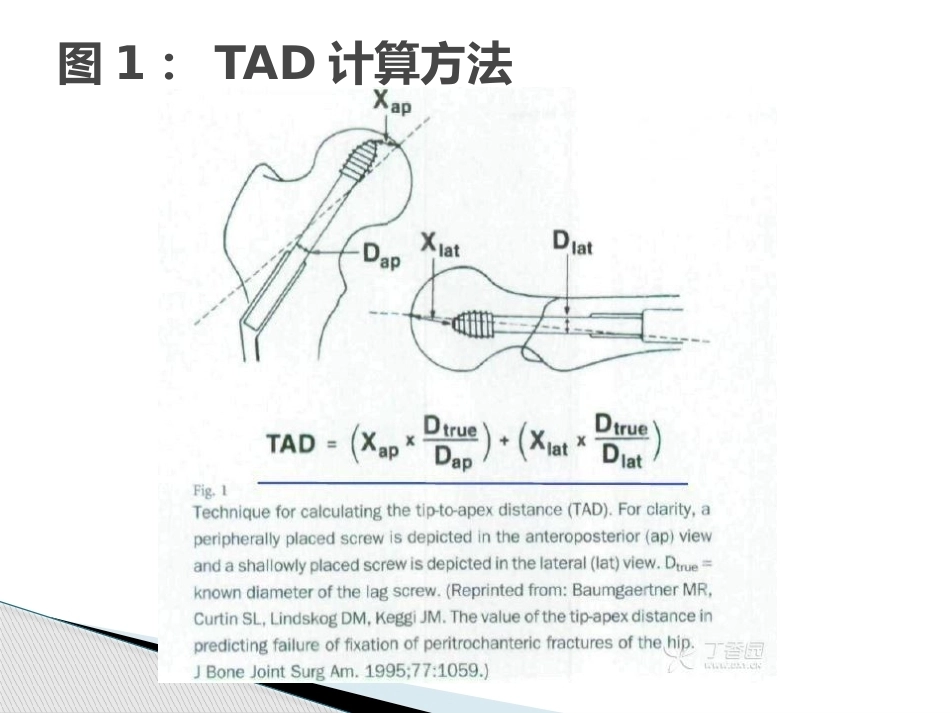 3.转子间骨折的十个手术技巧_第4页