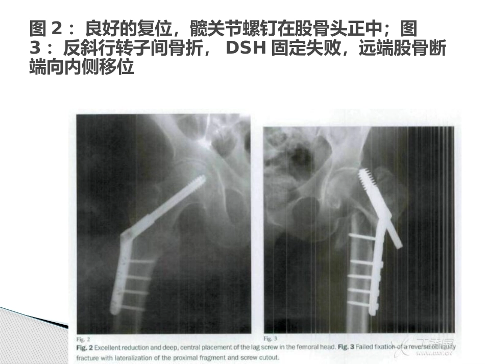 3.转子间骨折的十个手术技巧_第5页