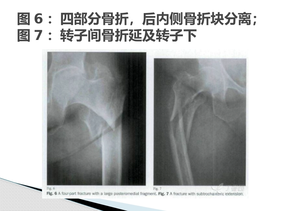 3.转子间骨折的十个手术技巧_第9页