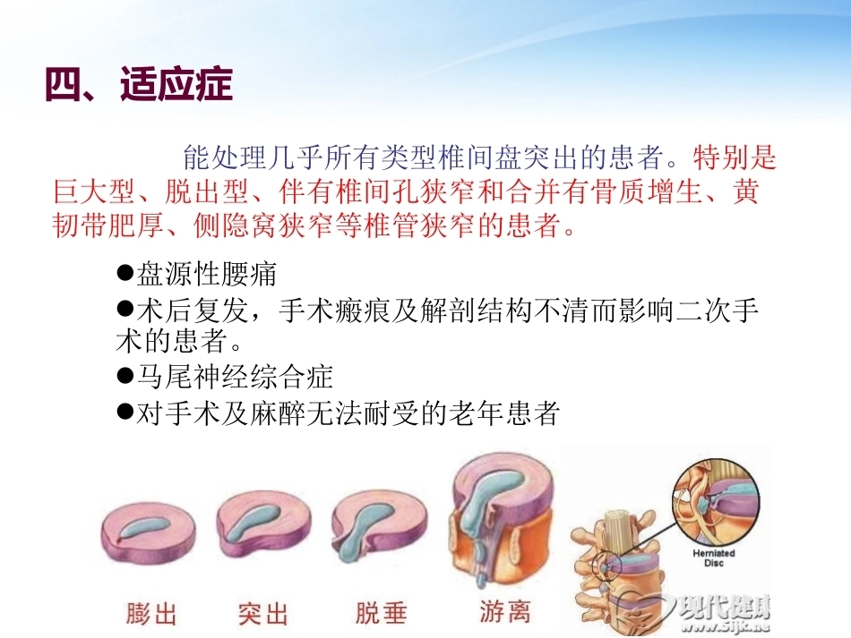 3椎间孔镜技术_第14页