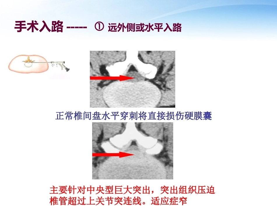 3椎间孔镜技术_第6页