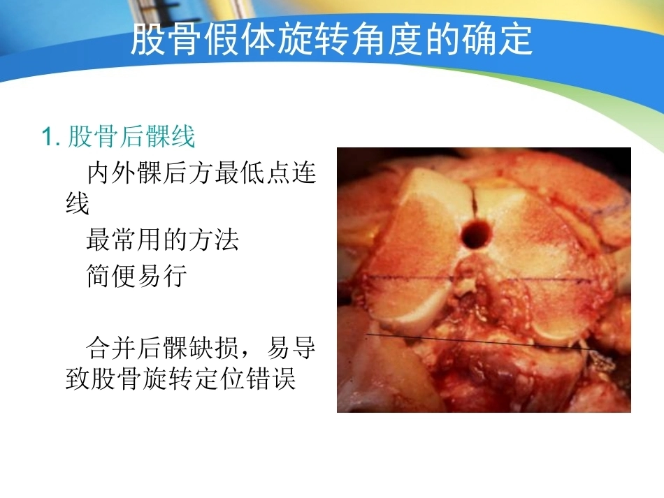全膝关节置换术力线(4)_第14页