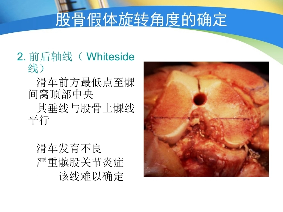 全膝关节置换术力线(4)_第15页