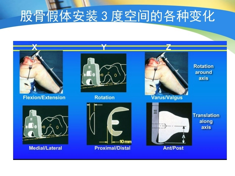 全膝关节置换术力线(4)_第8页