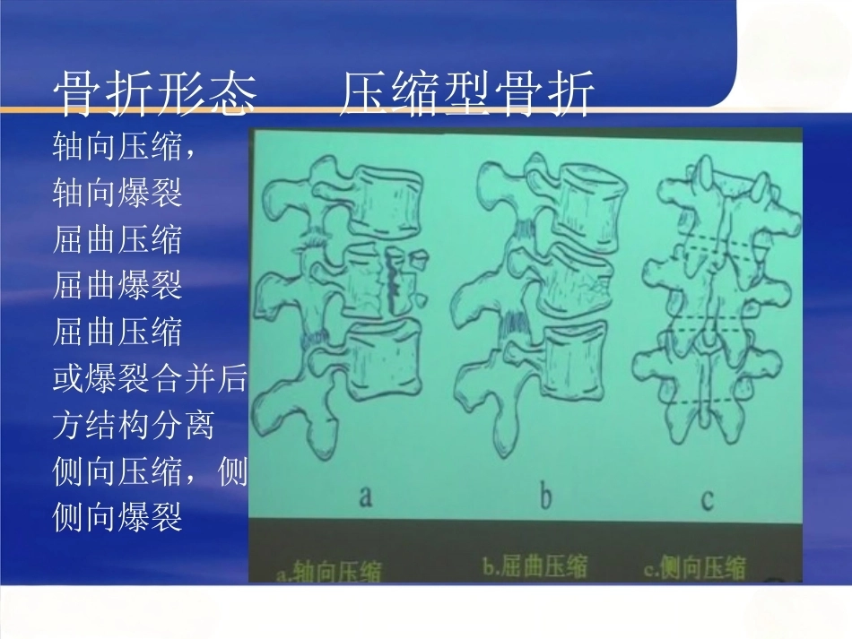胸腰椎骨折选择治疗(4)_第13页