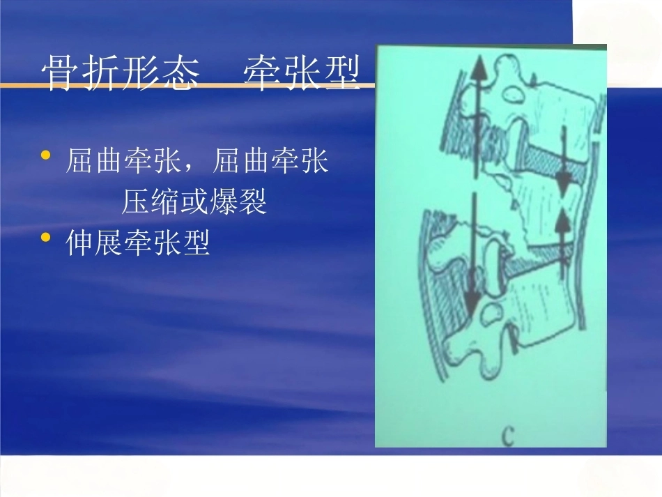 胸腰椎骨折选择治疗(4)_第15页