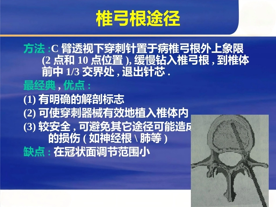 4椎体成形术_第15页