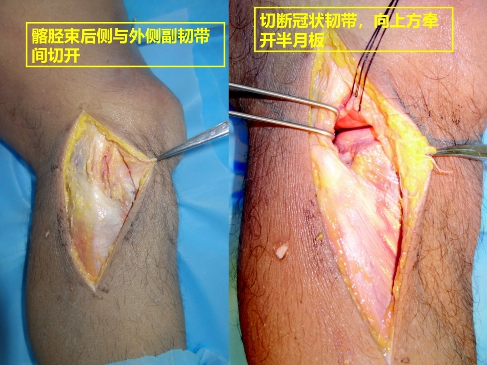 平台后外侧4种入路解剖观察_第14页