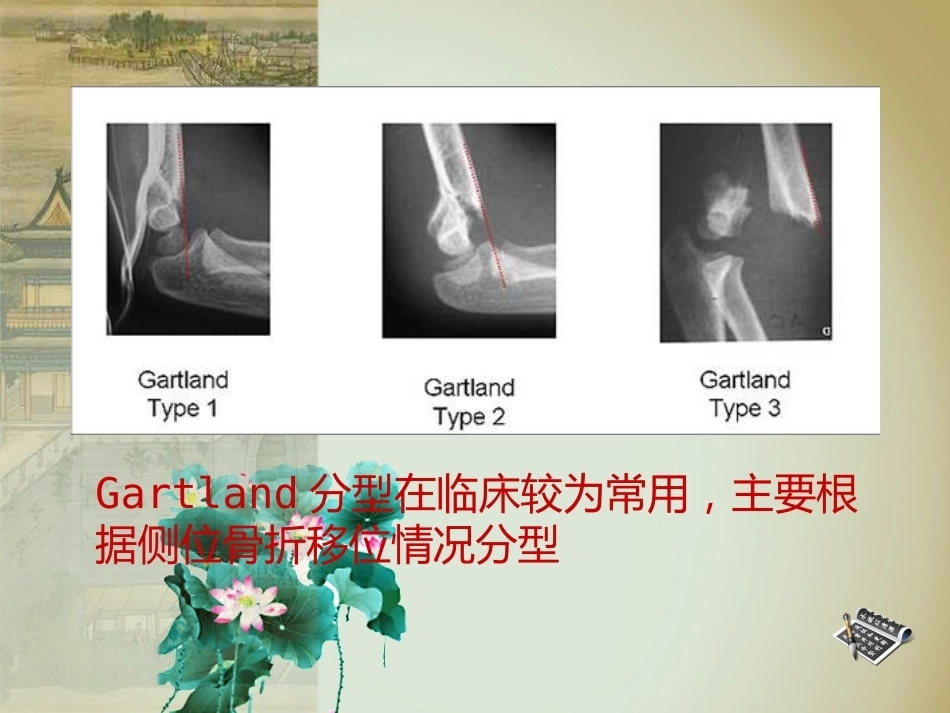 杨氏4步法治疗肱骨髁上骨折_第11页