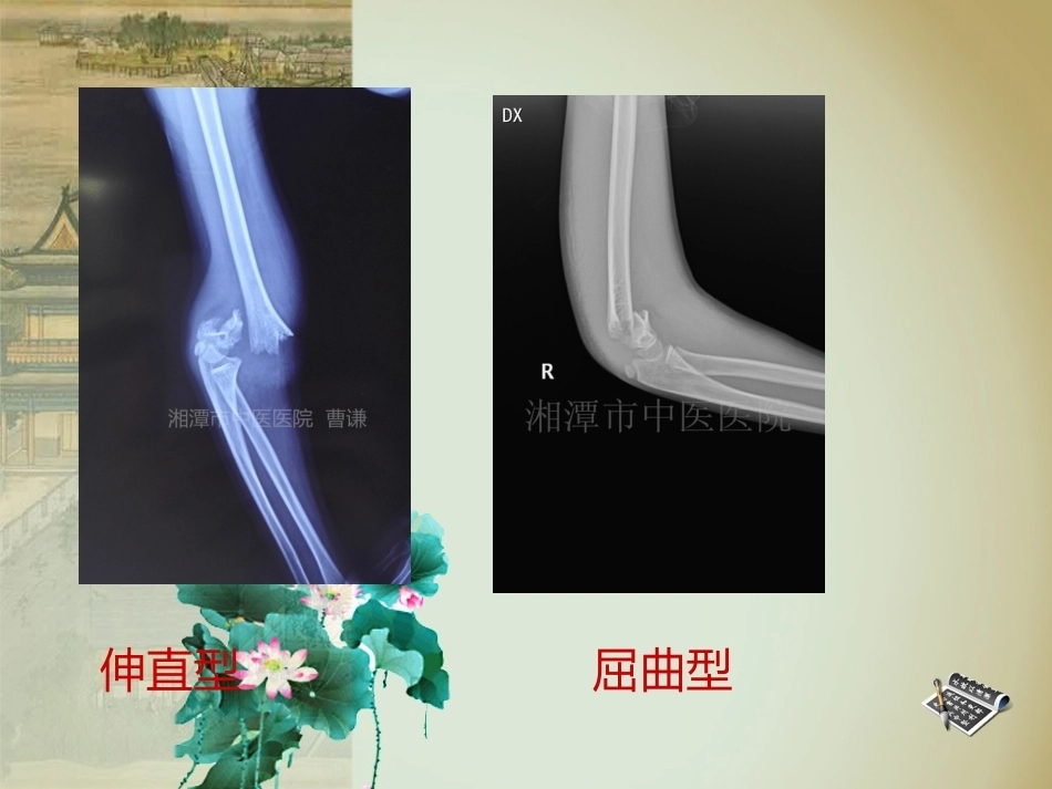 杨氏4步法治疗肱骨髁上骨折_第12页