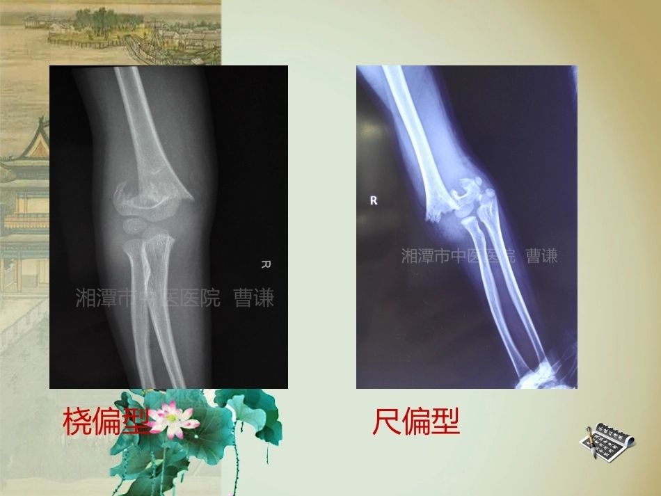 杨氏4步法治疗肱骨髁上骨折_第13页