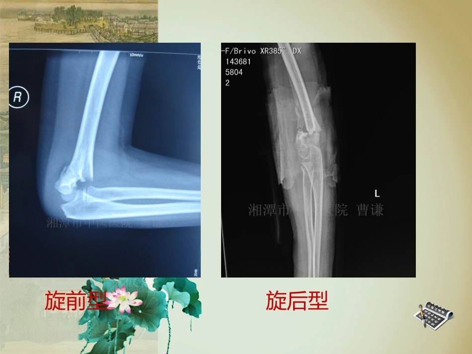杨氏4步法治疗肱骨髁上骨折_第14页