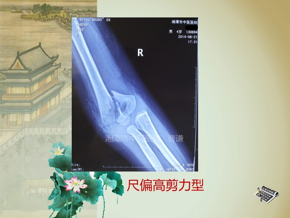 杨氏4步法治疗肱骨髁上骨折_第15页