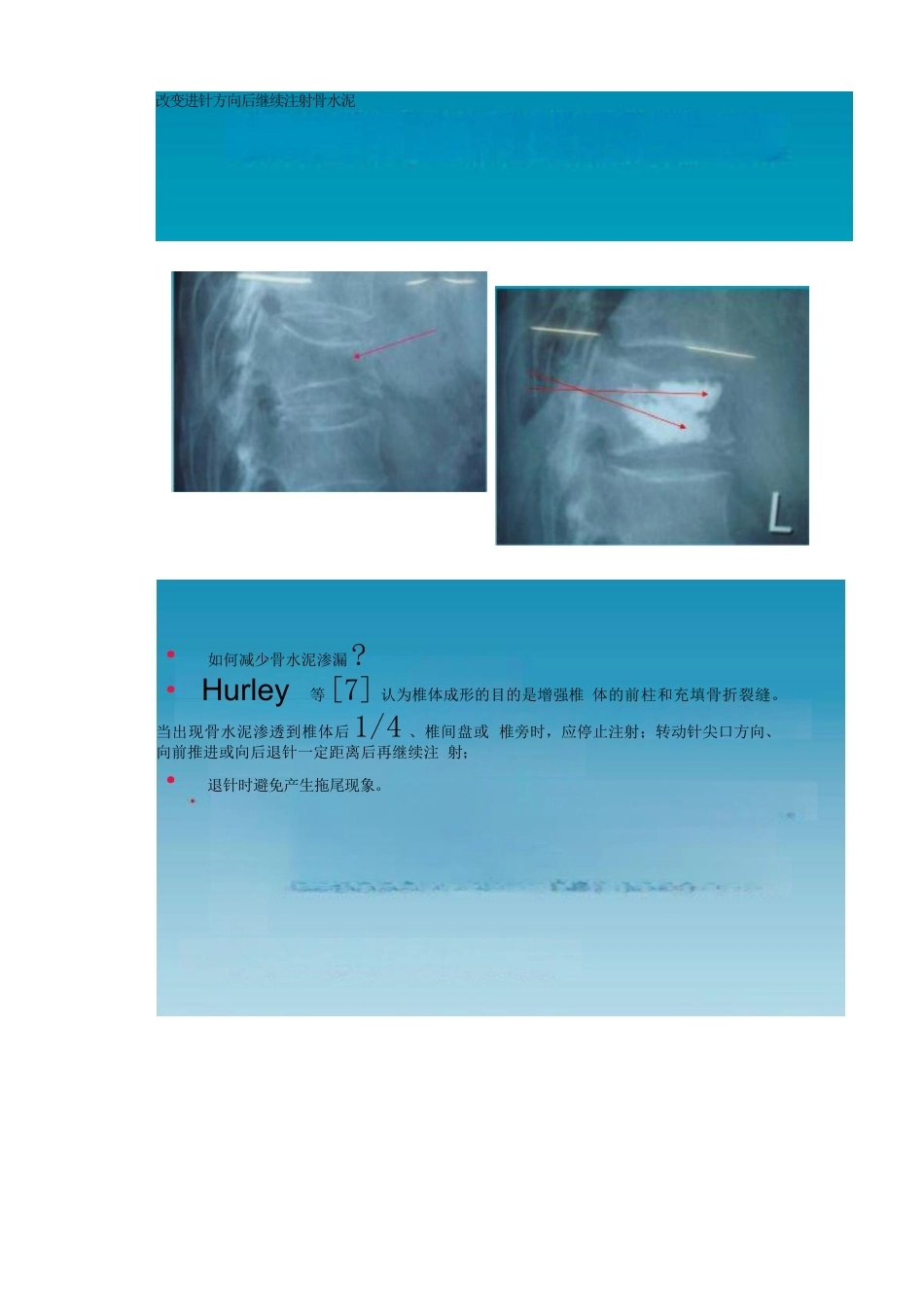 5椎体成形术的操作技巧及要点_第15页