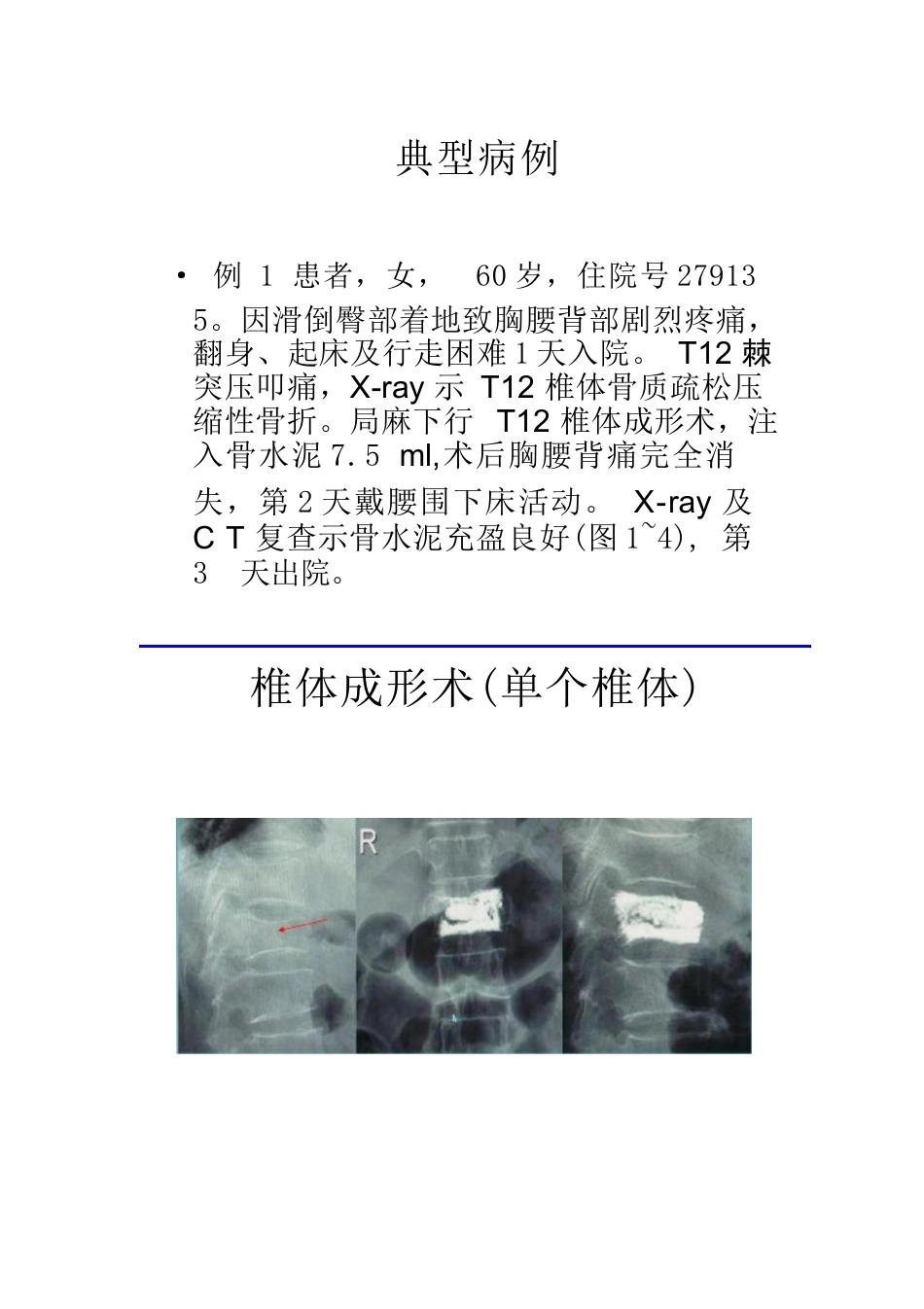 5椎体成形术的操作技巧及要点_第4页