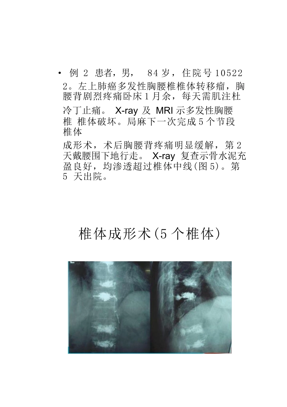 5椎体成形术的操作技巧及要点_第5页