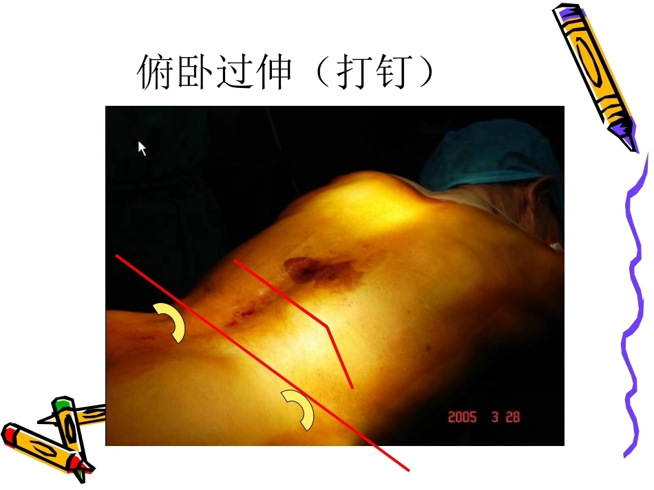 6椎体成形术手术步骤_第14页