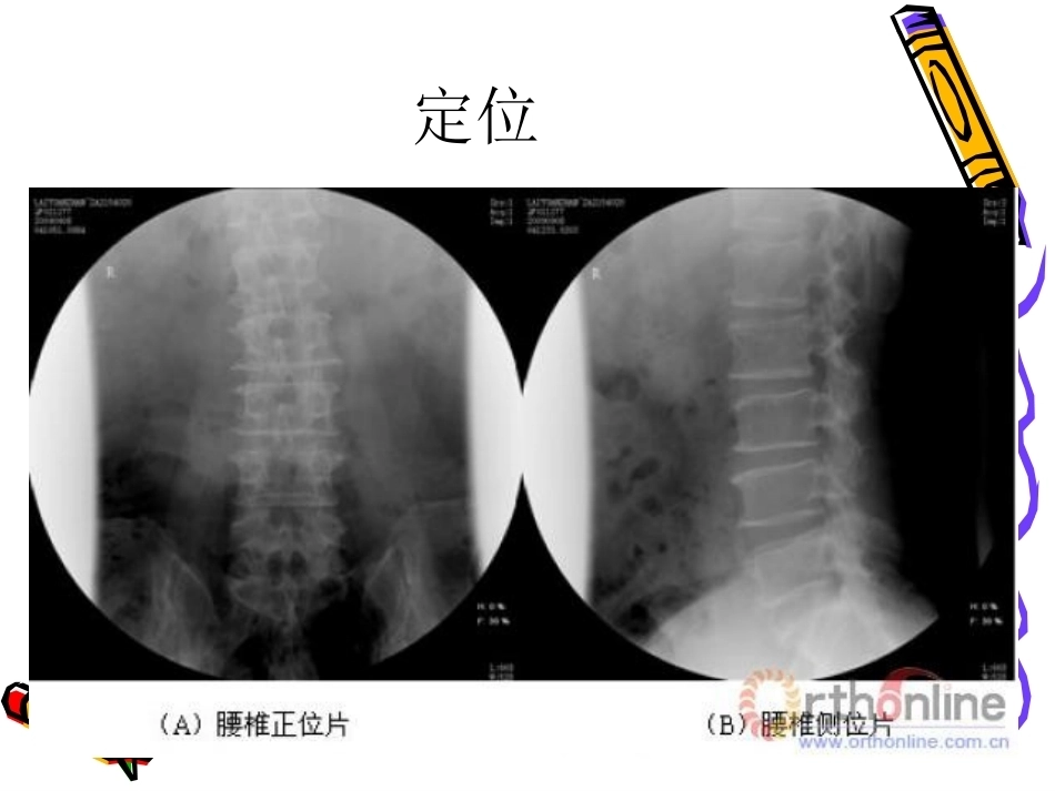 6椎体成形术手术步骤_第15页