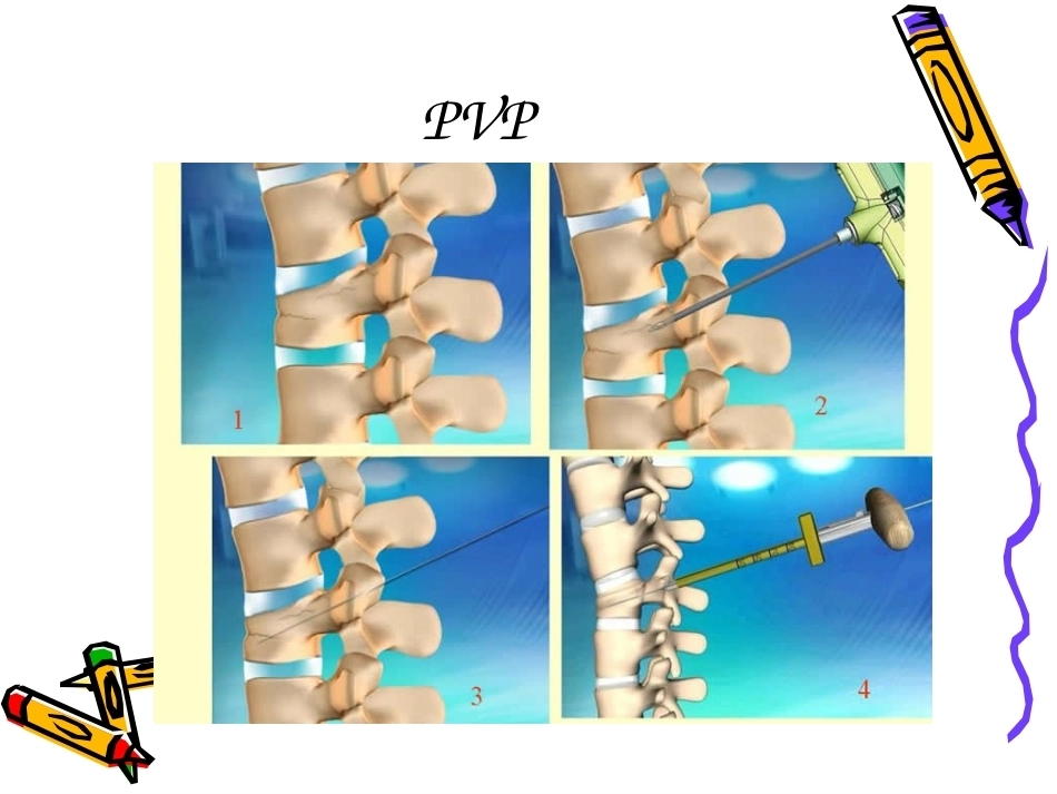 6椎体成形术手术步骤_第3页